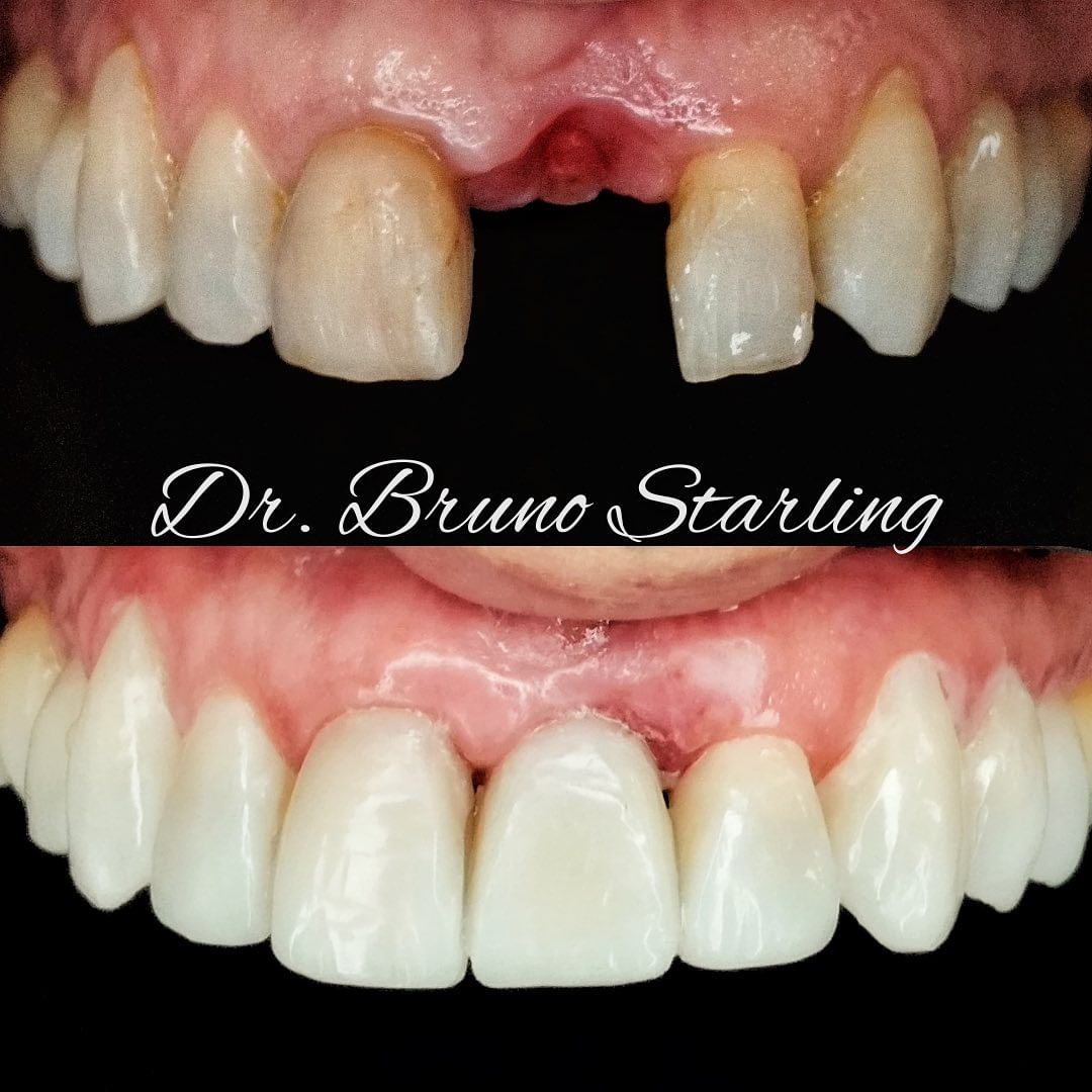 Resultado de Implante 4